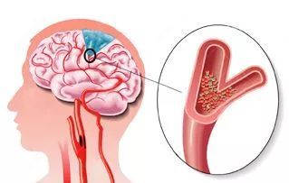 脑卒中病发的征兆你知道多少
